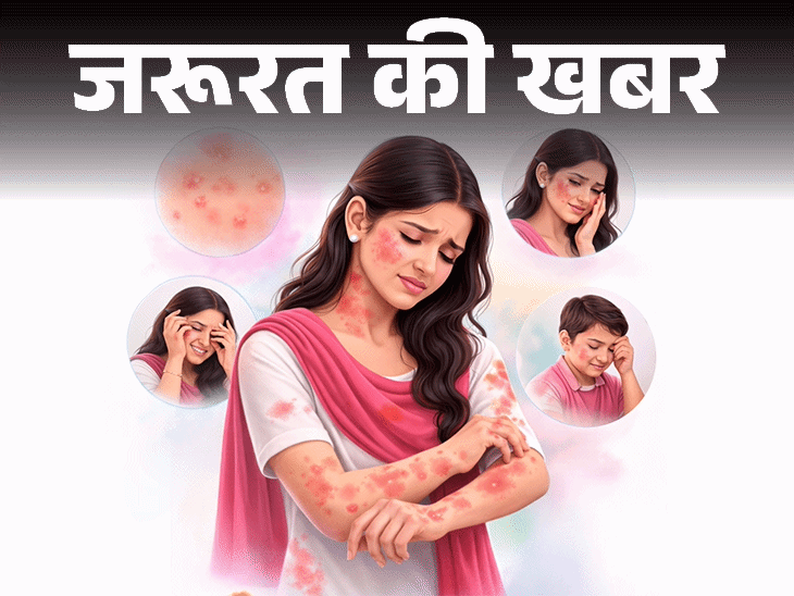 जरूरत की खबर- होली रंगों से स्किन पर रैशेज, दाने:  डर्मेटोलॉजिस्ट से जानें 10 घरेलू इलाज, ये 6 संकेत दिखें तो तुरंत डॉक्टर को दिखाएं