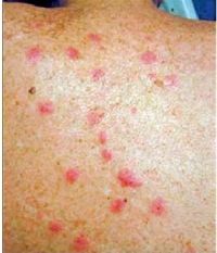 Fever and body rashes in summer, every fifth patient affected