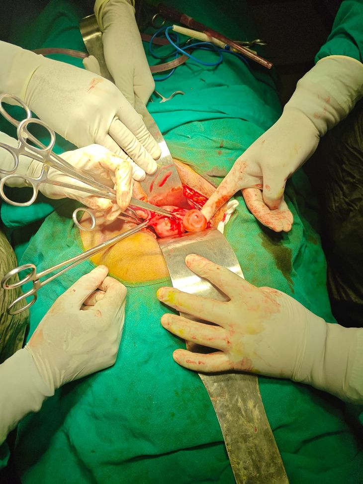 A complex operation on a 60-year-old patient was successful at Verma ...