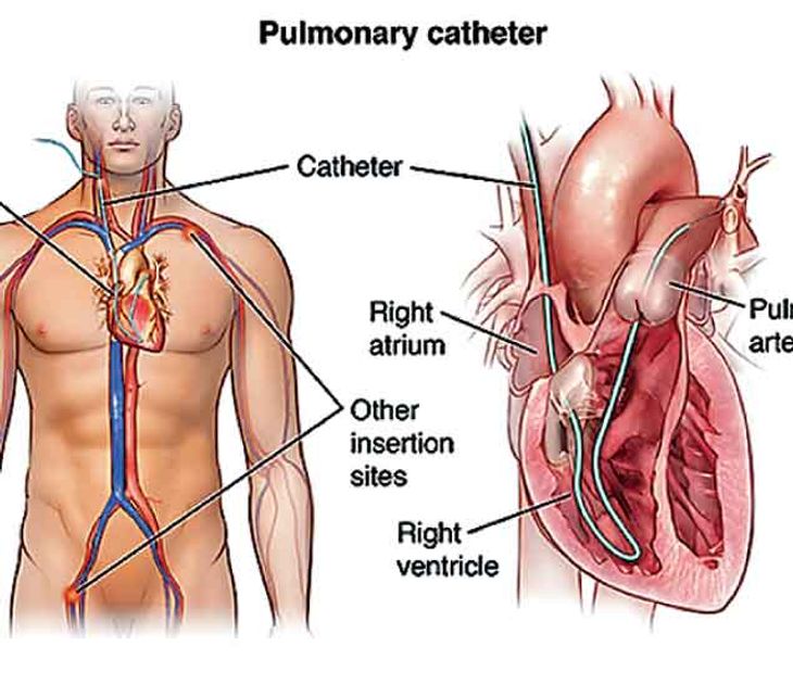 Катетеризация правых отделов сердца при легочной. Чрезвенозная катетеризация сердца. Катетер swan-ganz. Чрезвенозная катетеризация правых отделов сердца. Центральный венозный катетер постановка.