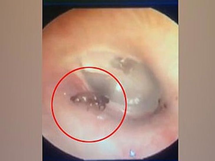 bug crawling in mans ear | अनेक दिवसांपासून कानातून येत होता ढोल ...