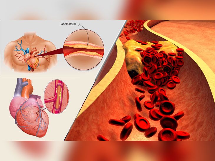 high cholesterol symptoms information in marathi शरीरातील कोलेस्टेरॉल वाढल्यास होऊ शकतात हे