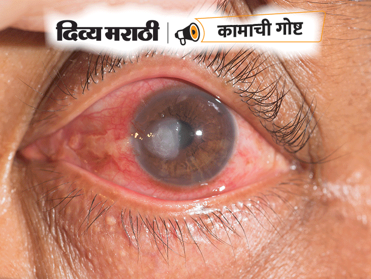 fungal infection symptoms treatment explained Health News बुरशी