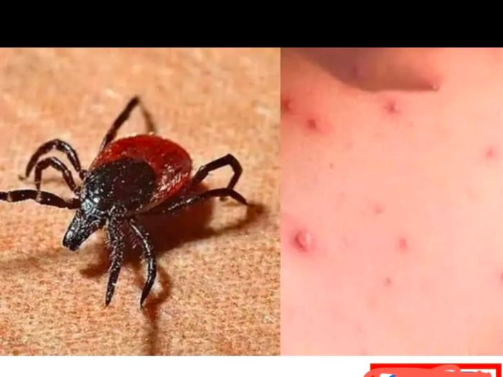 स्क्रब टायफस: पवार यांच्या भाचीवरही उपचार सुरु:  कुटुंबियांतील दोघींची प्रकृती स्थिर, गावात भीतीचे वातावरण – Amravati News