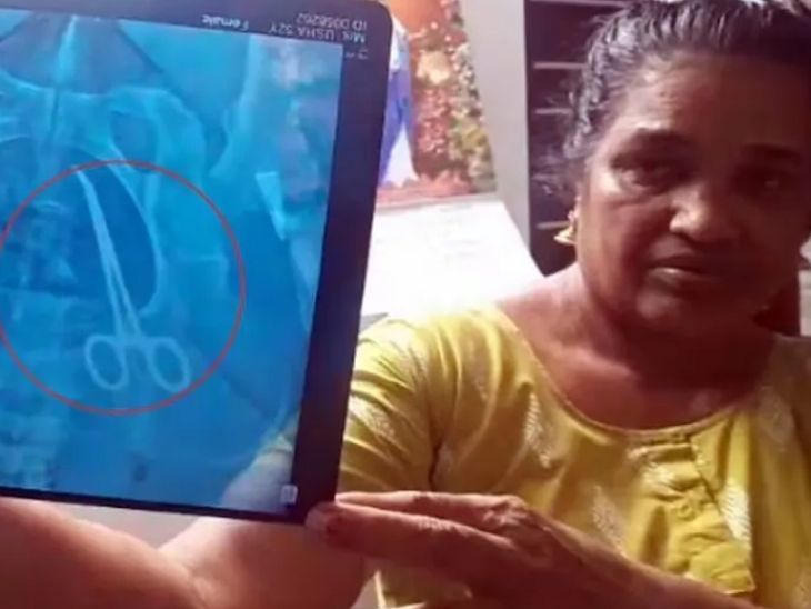 महिलेच्या पोटात कात्रीसारखे सर्जिकल टूल: एक्स-रेमध्ये उघड झाले, म्हटले- 5 वर्षांपूर्वी शस्त्रक्रिया झाली होती, तेव्हा डॉक्टरांची हलगर्जी महिलेच्या पोटात कात्रीसारखे सर्जिकल टूल: एक्स-रेमध्ये उघड झाले, म्हटले- 5 वर्षांपूर्वी शस्त्रक्रिया झाली होती, तेव्हा डॉक्टरांची हलगर्जी