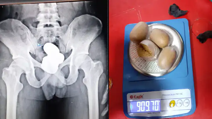 Gold worth Rs 42 lakh was found in the person's stomach, 908 grams of ...
