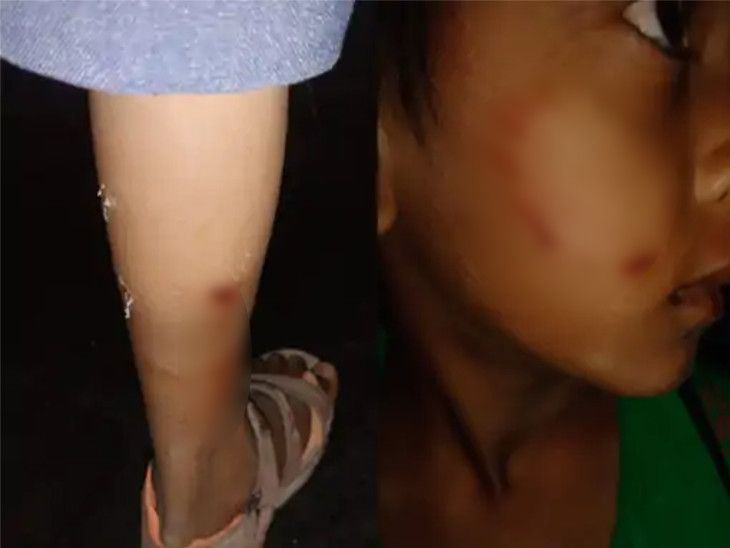 Dogs attacked two girls in Bhestan, Surat, locals rescued them from the ...