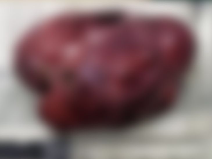 Gandhinagar Civil Hospital successfully operated on a tennis ballsized