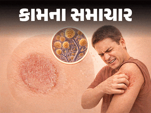 Ringworm Alert: Summer Rash Danger; Doctors Tips | Symptoms & Treatment