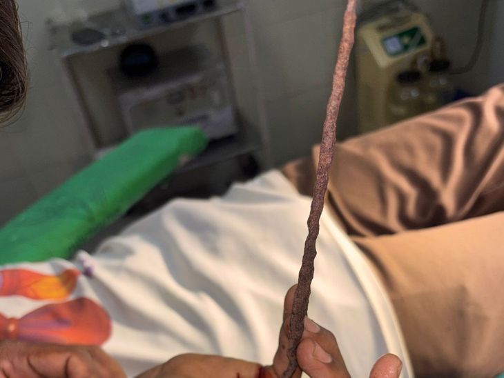 Surendranagar Hospital Saves Youth; Rusted Iron Rod Successfully Removed