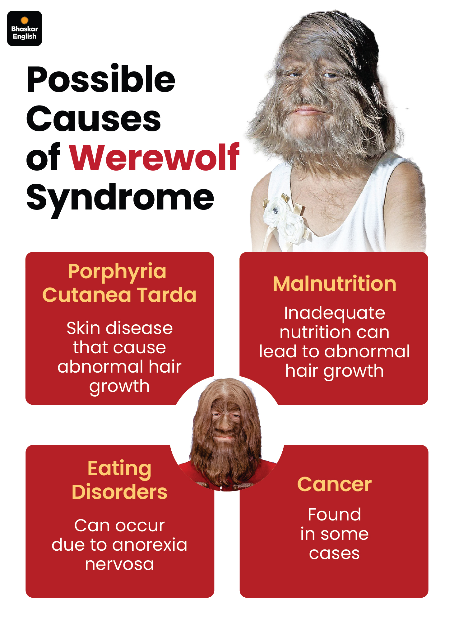 Understand the rare condition that causes excessive hair growth on the