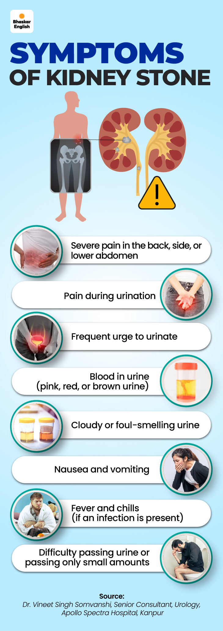 Kidney stone cases rise in summer dehydration sugary foods poor ...