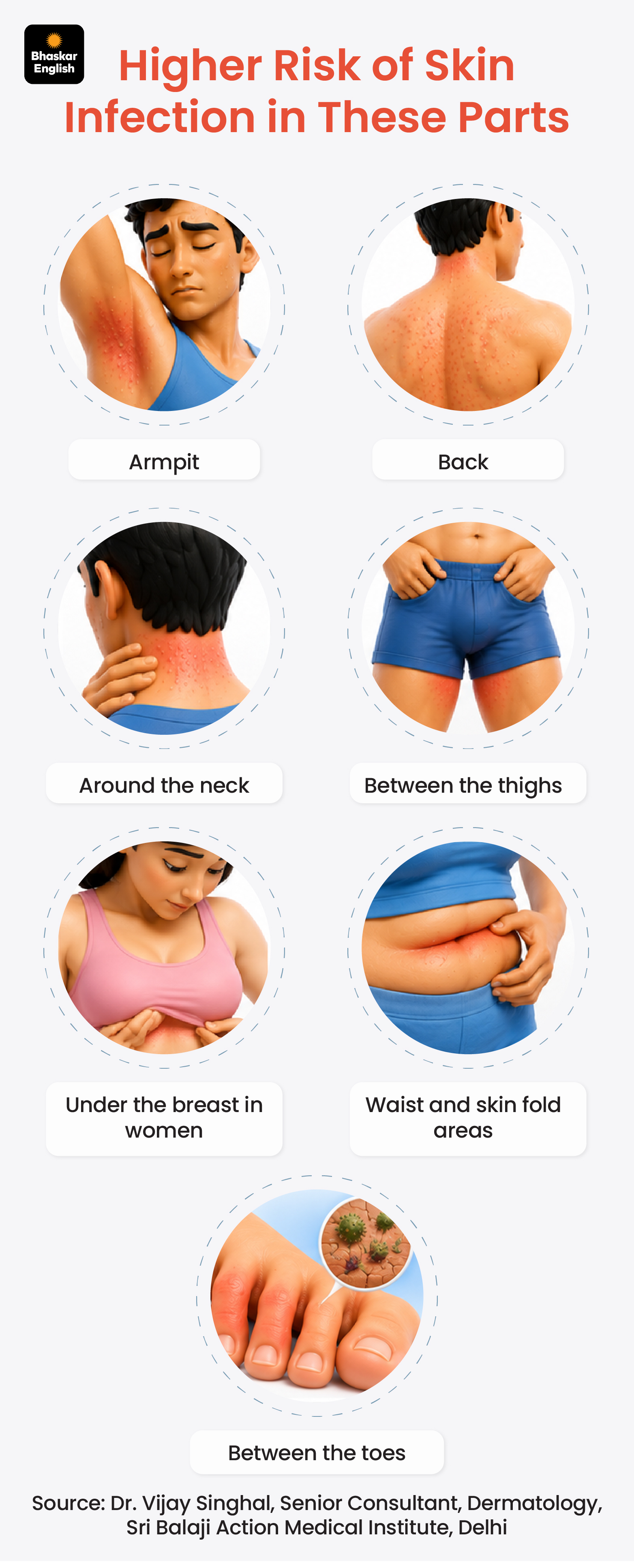 Skin Rash Sweating Infection Skin Rash Summer Tips | 10 Dermatologist Prevention Ideas