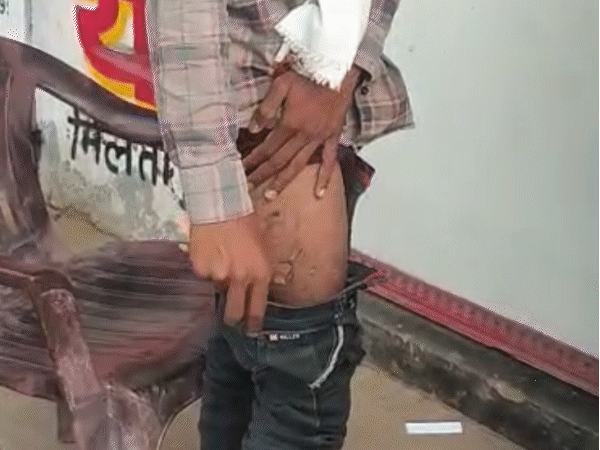 पन्ना में जेब में रखा मोबाइल फटने से युवक झुलस गया. - भास्कर इंग्लिश