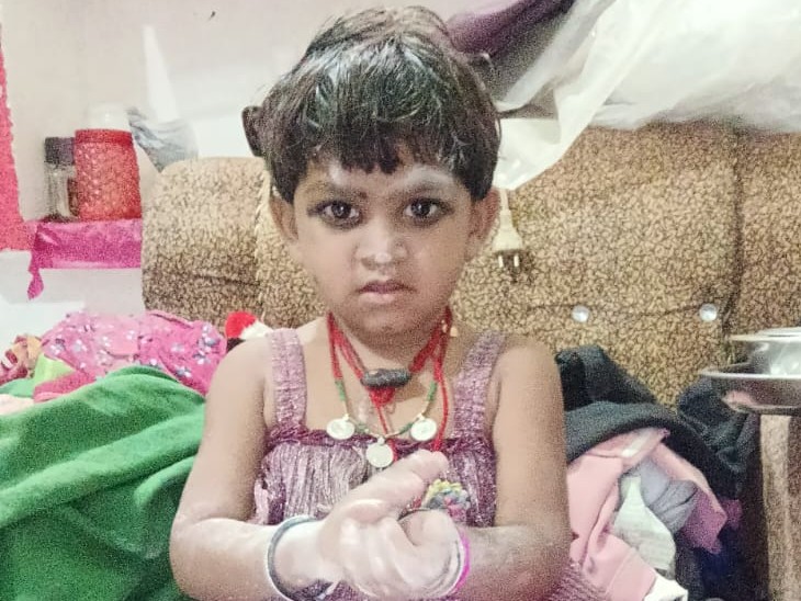 जलने और मलबे में फंसने से बच्ची की मौत - भास्कर इंग्लिश
