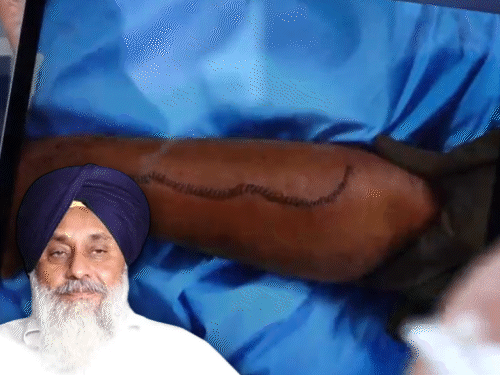 Stitches on Sukhbir Badal's arm. Inset shows photo of Sukhbir Badal - Bhaskar English