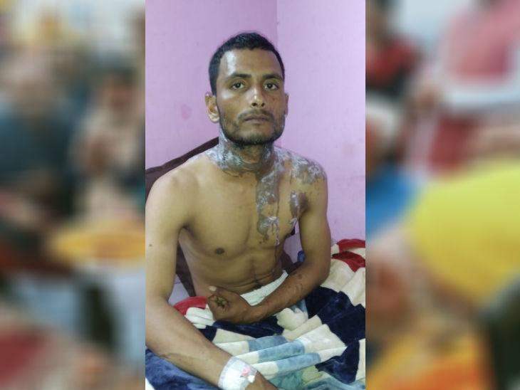 उन्नाव में युवक पर युवती ने फेंका तेजाब, लखनऊ रेफर किया गया; आरोपी लड़की हिरासत में|कानपुर,Kanpur - Dainik Bhaskar