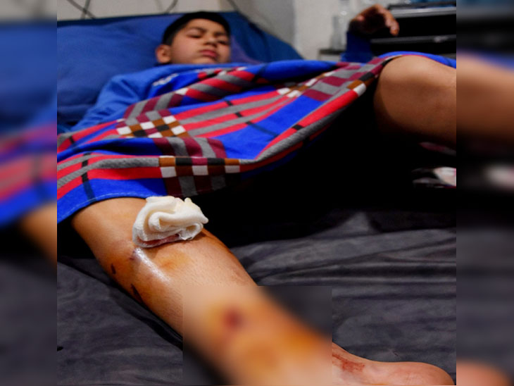 जालंधर में पिटबुल कुत्ते ने बच्चे की टांग नोची, 10 मिनट बाद बच्चे ने जबड़ा पकड़ खुद को छुड़ाया|जालंधर,Jalandhar - Dainik Bhaskar