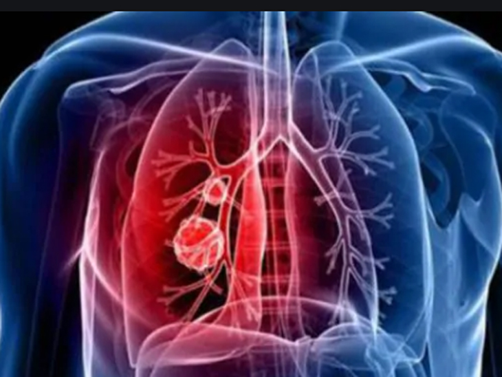 अपनी हेल्थ से खिलवाड़ करने से बढ़ रहे कैंसर के मरीज|चंडीगढ़,Chandigarh - Dainik Bhaskar