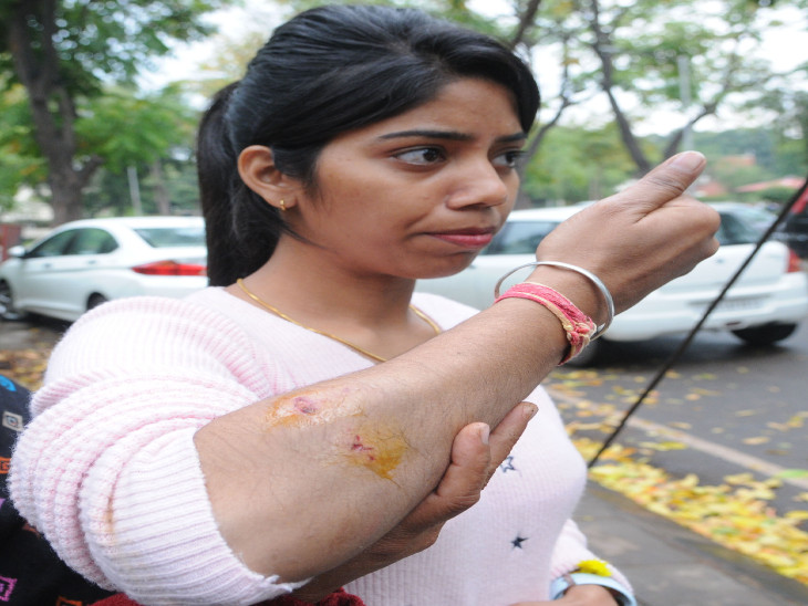 पिटबुल के काटने के बाद बाजू दिखाती लवली - Dainik Bhaskar