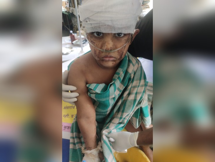 मोहम्मद बांगी नाम का यह बच्चा ठीक है। फिलहाल जिला हॉस्पिटल में भर्ती है।