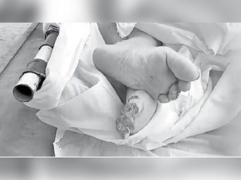 पैर की कई अंगुलियां चूहों ने कुतर ही डाली।