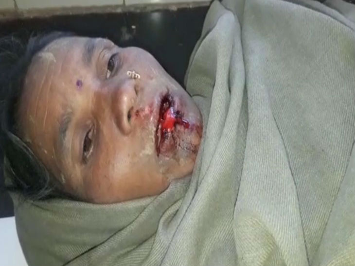 हादसे में घायल सीताबाई का दांत टूट गया