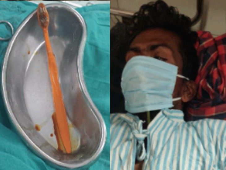 Man Swallowed Toothbrush! Now What? Accidentally While Cleaning Teeth