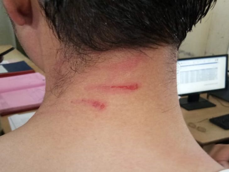 विशाल के गले में भी खरोच के निशान हैं।