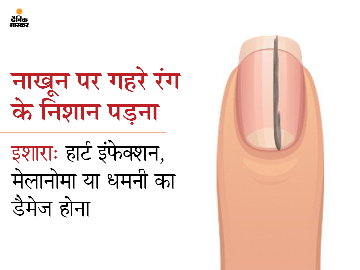 Repeated nail breakage indicates your vitamin A and C deficiency Its