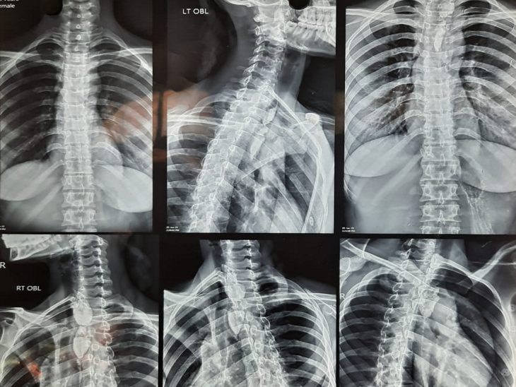 एक्सरे रिपोर्ट देखने के बाद डॉक्टरों ने टीम ने 8 घंटे जलिट ऑपरेशन किया।