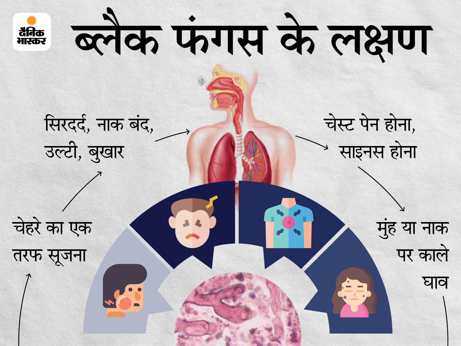 Symptoms Of Black Fungus In The Eyes In The State Injection Missing From The Market Not In Any Store छत त सगढ म क र न स ठ क ह ए क छ मर ज क आ ख म ब ल क