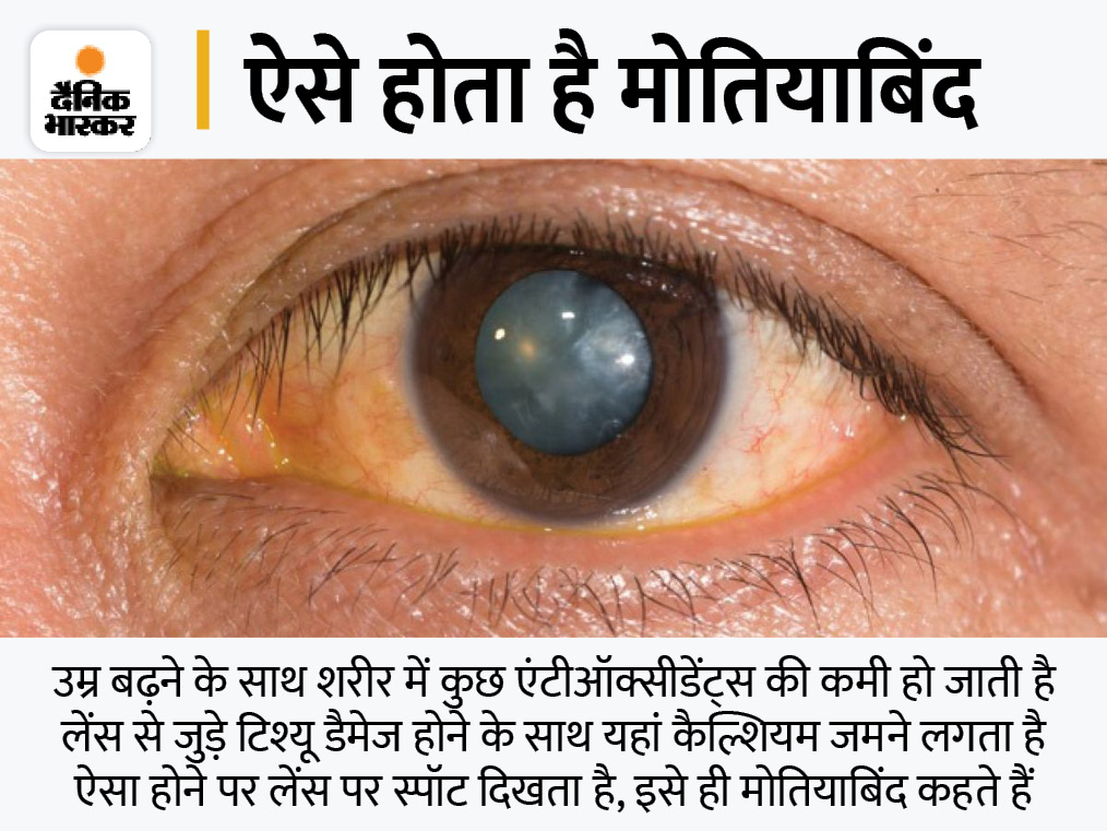Motiyabind Cataract Prevention; Scientists Develop Pellet Implant That