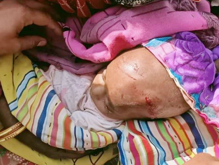 6 महीने के बच्चे के सिर पर गंभीर चोट आई थी।