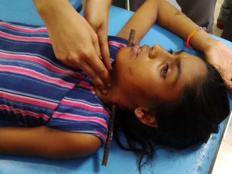बच्ची के गले में करीब सवा फुट का सरिया बचा रह गया। उसे एंबुलेंस से अस्पताल लाया गया।