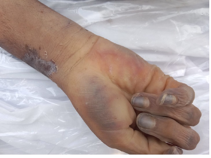 हथेली और नाखून भी हो गए थे काले