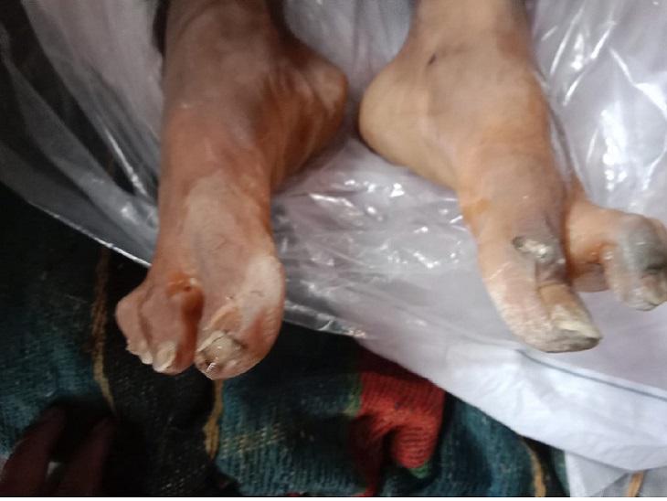 पैर में दिखे चोट के निशान, उखड़ गए थे नाखून