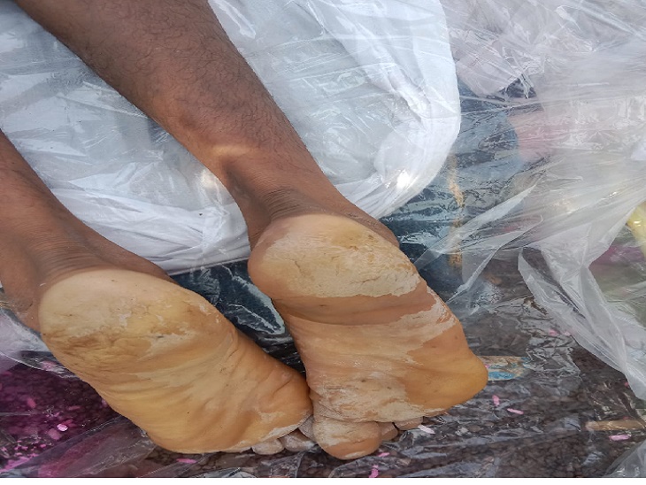 तलवों के साथ ही शरीर के कई हिस्सों में नजर आया चोट