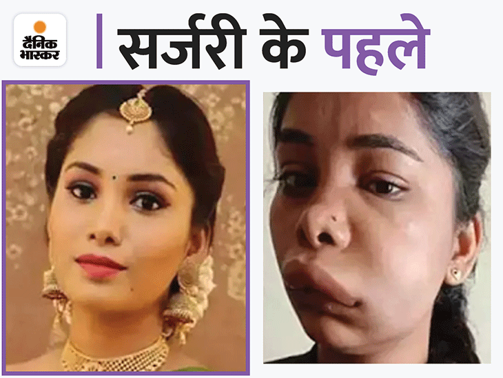 Kannada Actress Swathi Sathish Root Canal Surgery Procedure Sodium