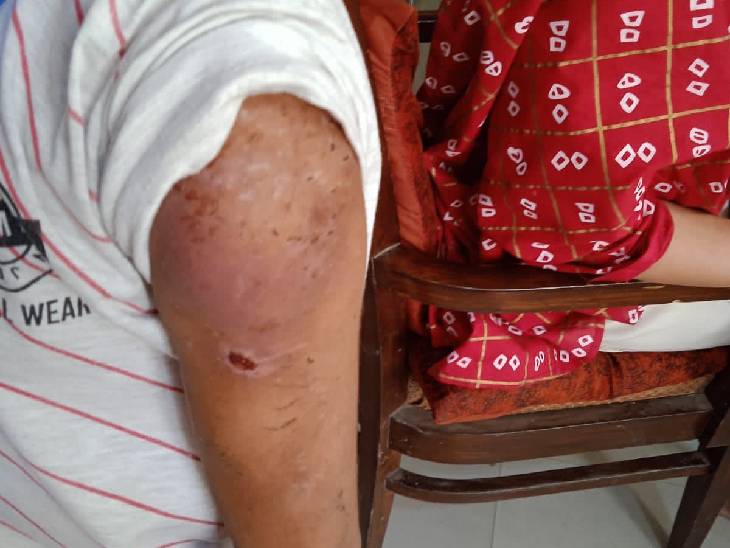 बच्ची के हाथ में घांव