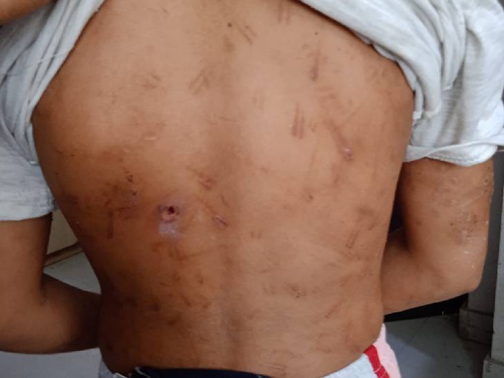 बच्ची की कमर पर चिमटे के निशान