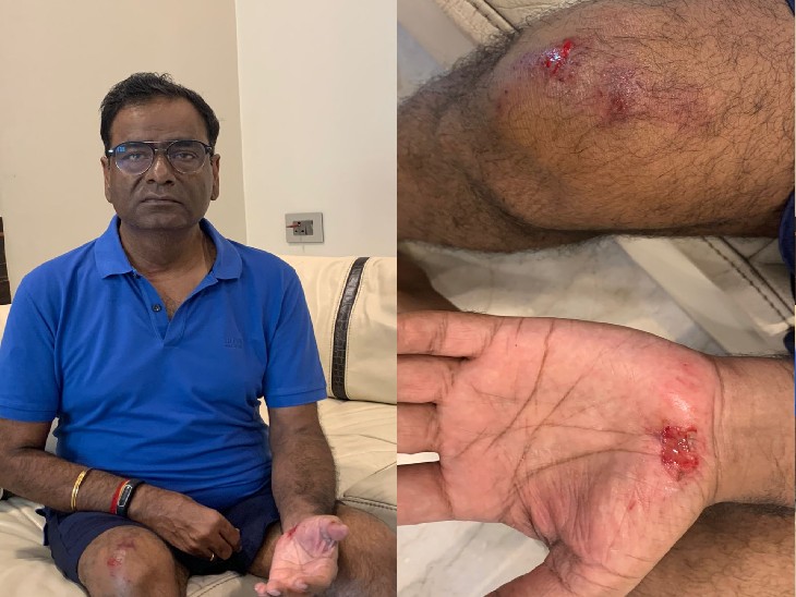 घायल सुशील कुमार और उनके हाथ व पैर में लगे चोट के निशान। - Dainik Bhaskar