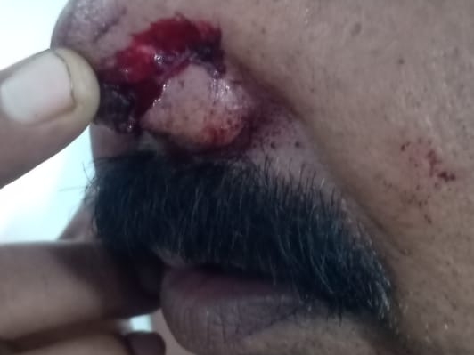बंदर के काटने से घायल पुलिसकर्मी।