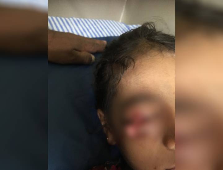 17 अगस्त को बांसखेड़ी में सात साल की बच्ची को कुत्ते ने नोंच दिया था। इससे बच्ची की आंख बुरी तरह से जख्मी हो गई थी।