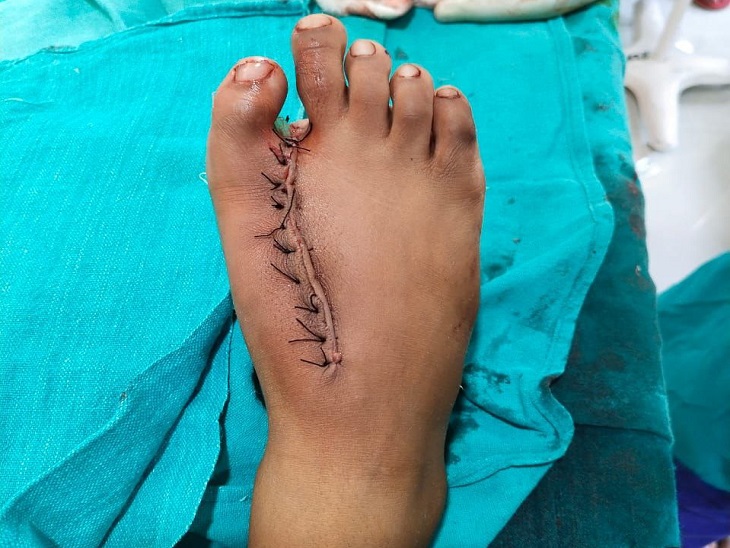 ऑपरेशन के बाद ठीक हुआ बच्चे का पैर