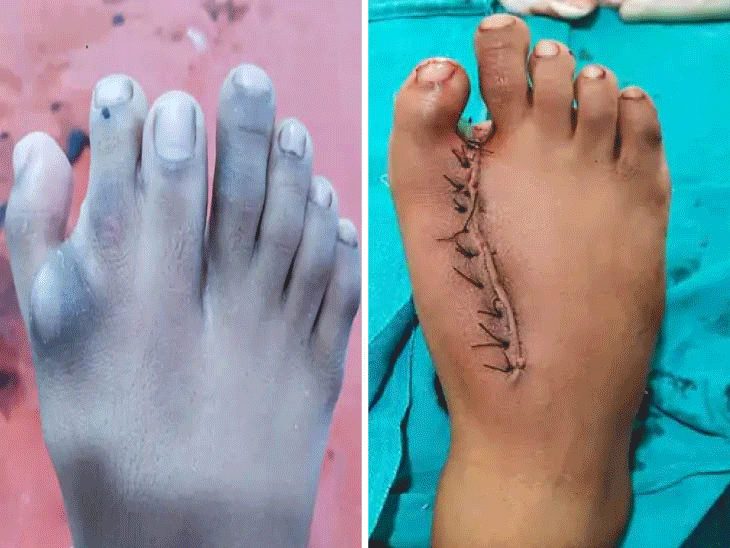 एक बच्चे के पैर में 7 उंगलियां - Dainik Bhaskar