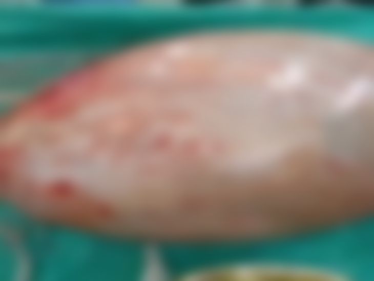 10 किलो का ट्यूमर महिला के पेट से निकाला गया।