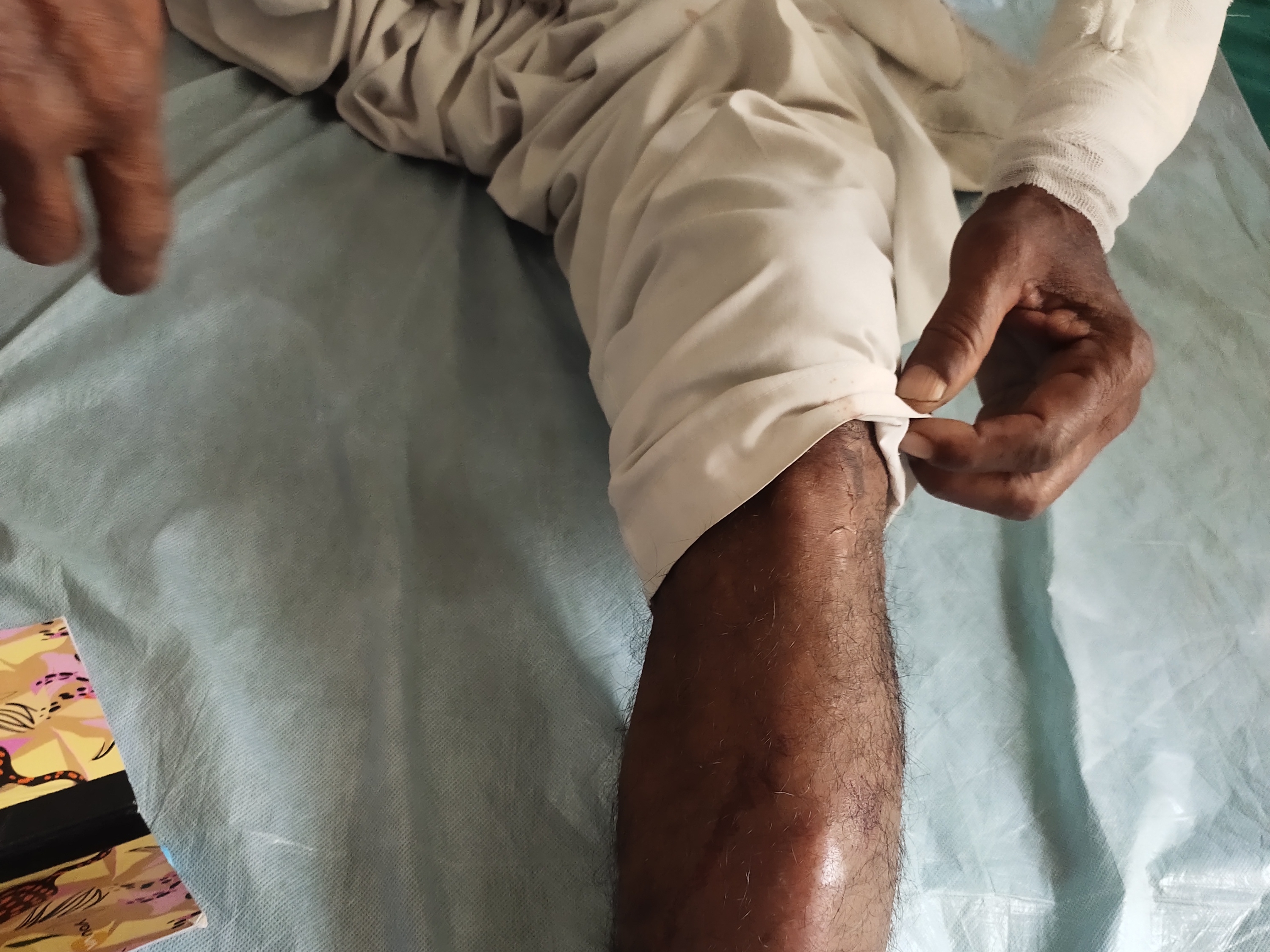 लाठी से टांग में लगी चोट दिखाता पीड़ित।