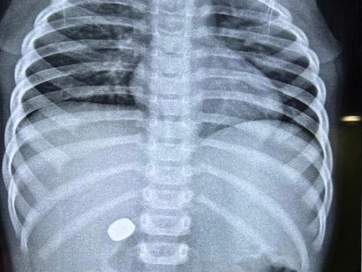 इस तरह पेट के अंदर फंसी थी बटन बैटरी