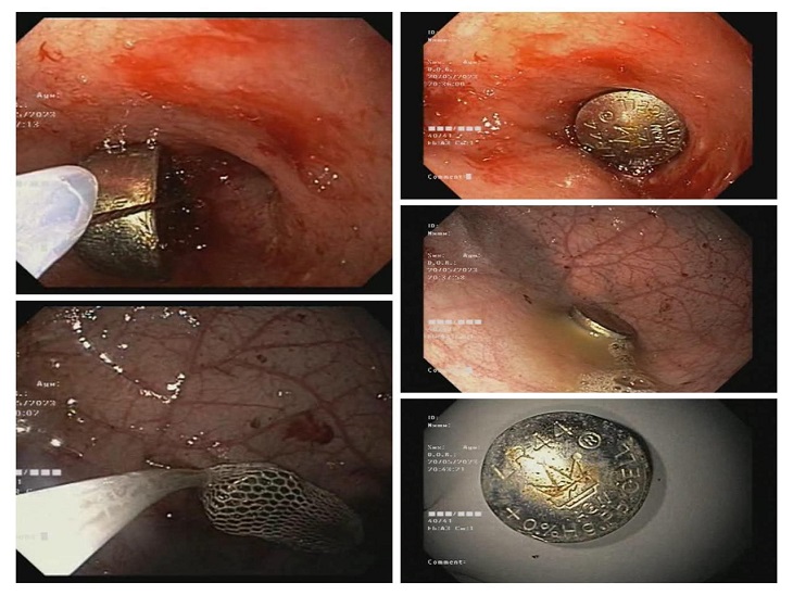बच्चे की छोटी आंत में इस तरह फंसी थी बटन बैटरी।
